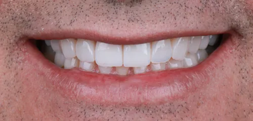 Depois - Desgaste por Bruxismo